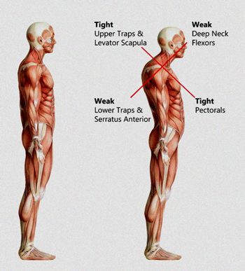 exercises up cross syndrome