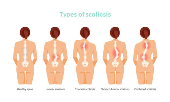 scoliosis different type