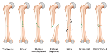 bone fracture type