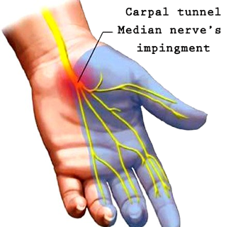 Carpal Tunnerl Median Nerve impingment